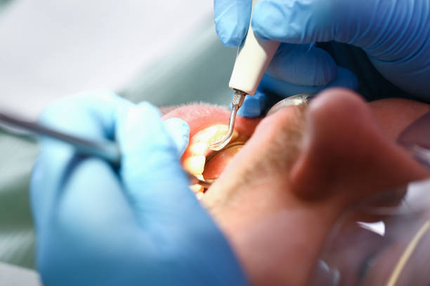Best Emergency Dental Care for Broken or Chipped Teeth in Fairmount, IN